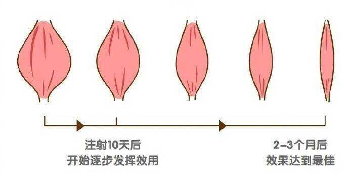 肉毒素注射咬肌后出现一侧咬肌突出是什么原因?