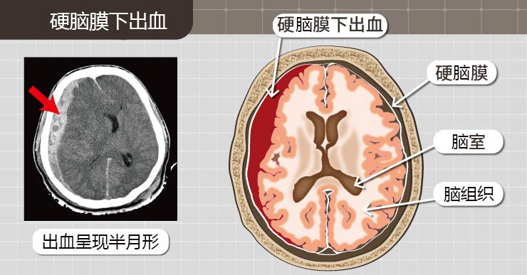 硬脑膜下出血