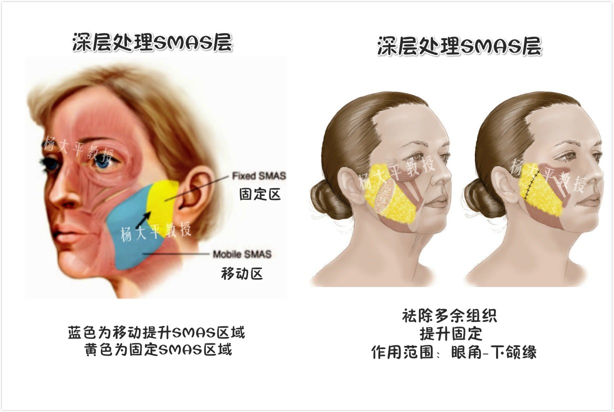 通过处理smas筋膜层来达到除皱效果的手术方式在国际上有这样几种技术