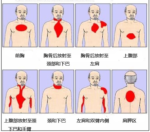 急性心肌梗死常见心前区疼痛,但出现以下位置疼痛也应该引起重视