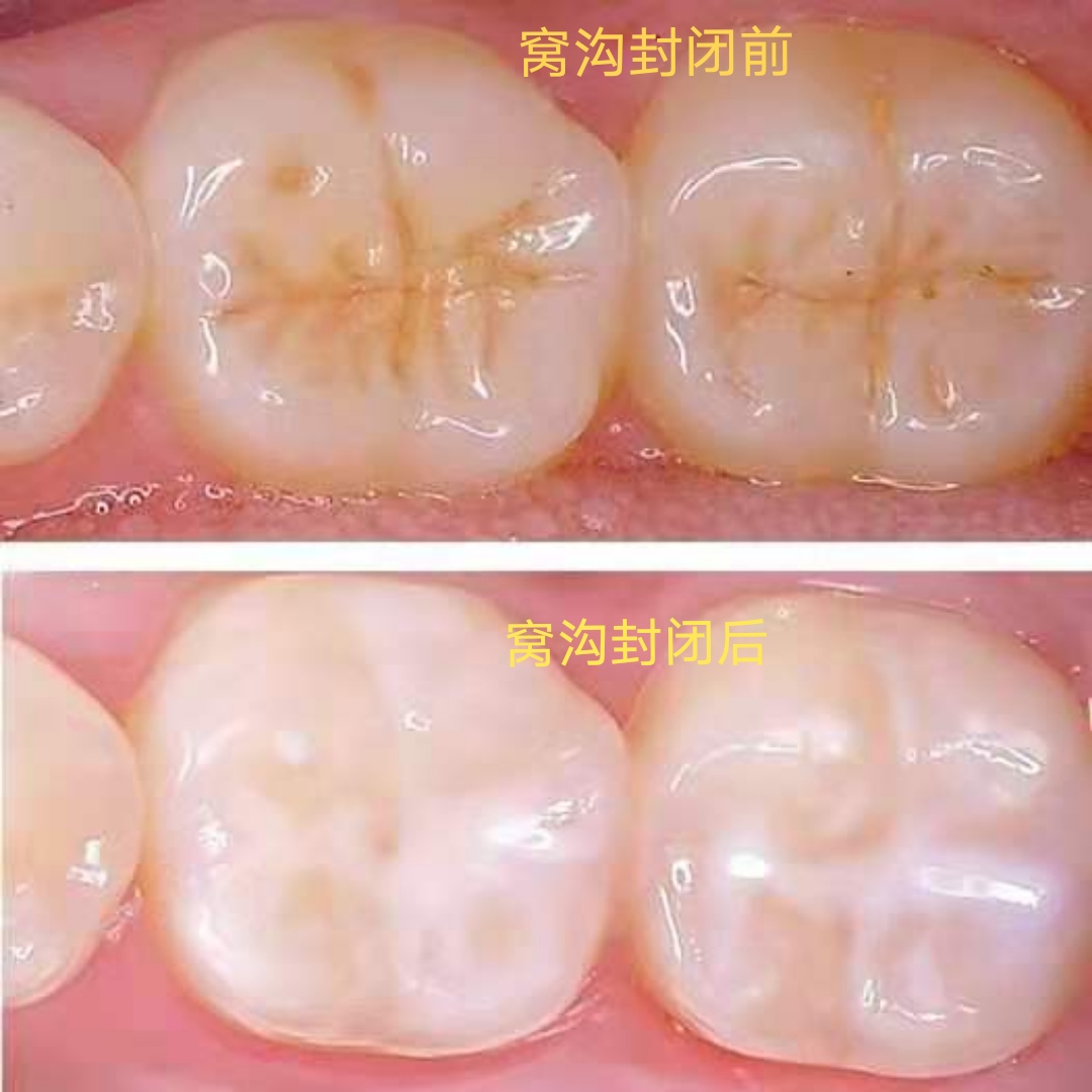 (2)6-7岁为六龄齿即第一恒磨牙窝沟封闭的最佳时间;    (3)11-13