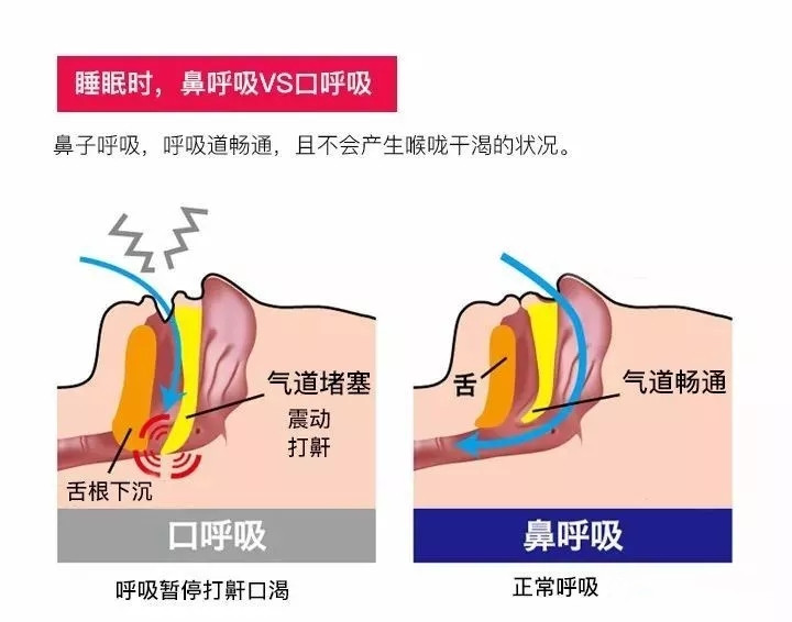 人在正常情况下的呼吸是通过鼻腔完成的,口呼吸是人们因慢性