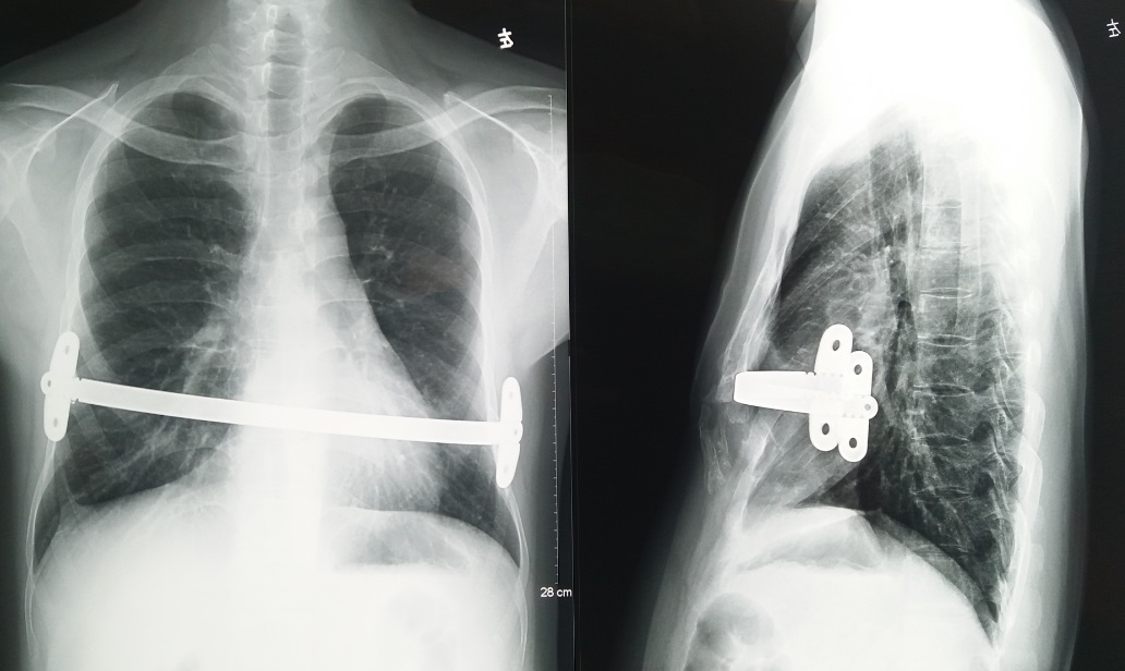 漏斗胸术后7年取钢板手术