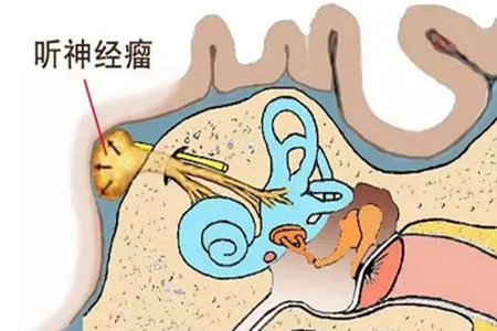 为什么有的听神经瘤患者会出现面部麻木的症状?