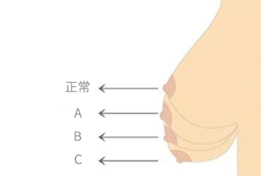 什么原因会导致胸部下垂?有哪些方法可以矫正胸下垂?