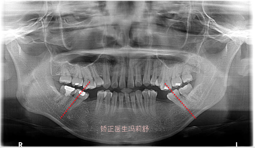 缺失牙临近的牙齿向缺隙处倾斜