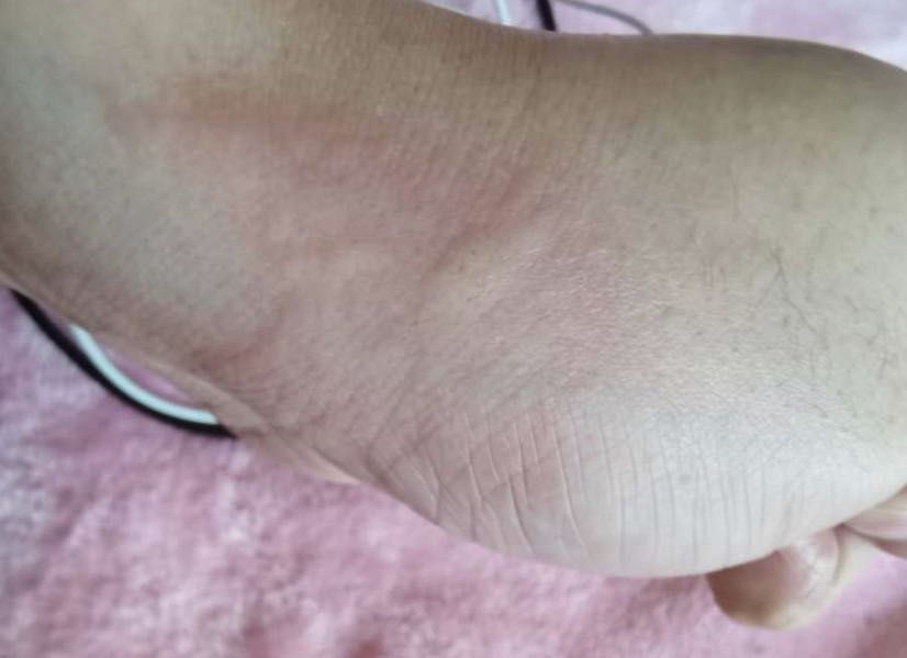 皮肤瘙痒,白天没感觉,晚上会一抓就成片,这会是什么原因?