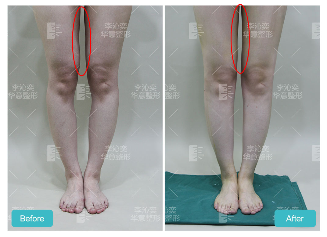 脂肪填充大腿的凹陷,会让腿变更粗吗?