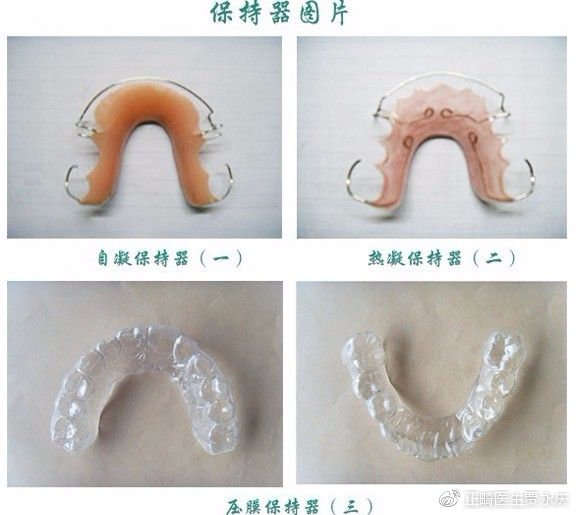 那么最后来说说固定保持器一般来说,需要长期,甚至永久保持的牙齿
