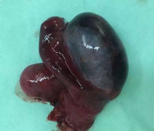 因为睾丸坏死与睾丸扭转时间有关,研究资料表明,病人在出现症状4h内