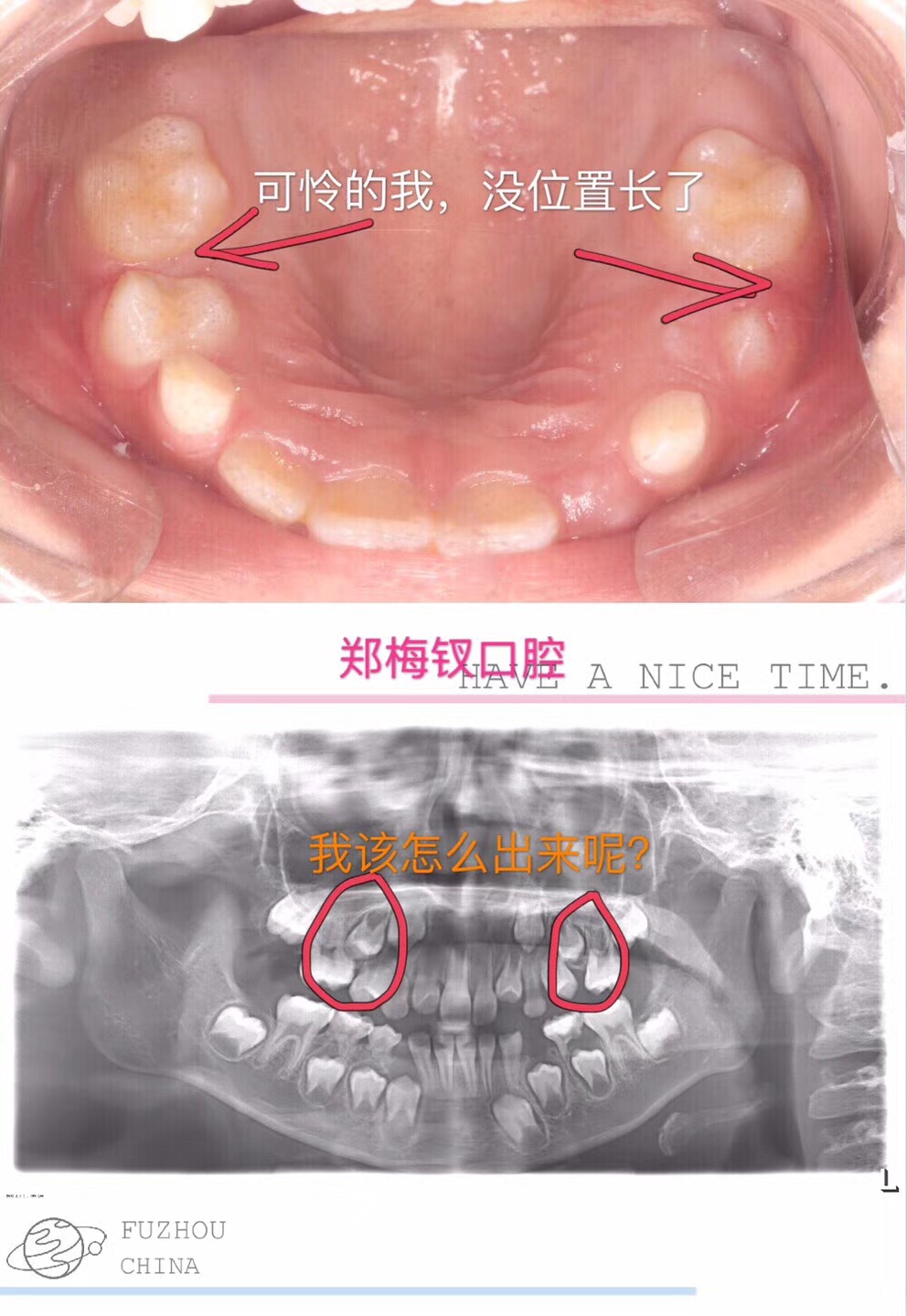 特别是乳磨牙,因为外伤,严重龋坏等原因过早丧失,在后面六龄牙萌出