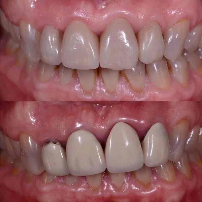 分享一例金属烤瓷牙因边缘密合度差导致牙龈萎缩后