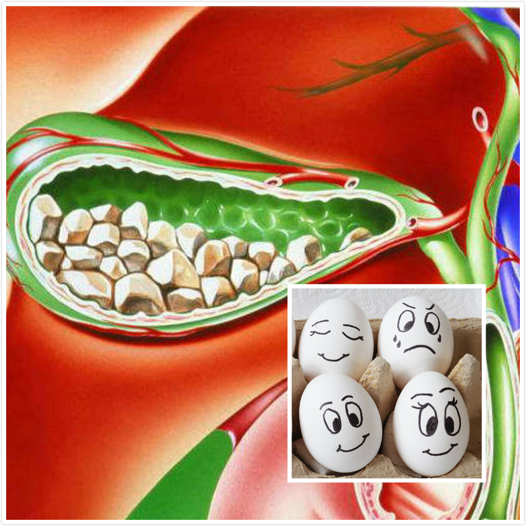 胆囊结石的认识误区—不痛就不用管?