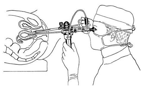 宫腔镜手术图片.jpg