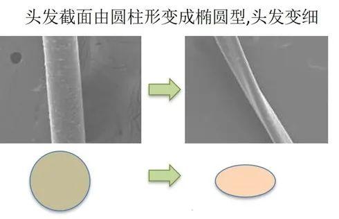 头发天生细软少,如何让增加发量?(附带女性发际线改善