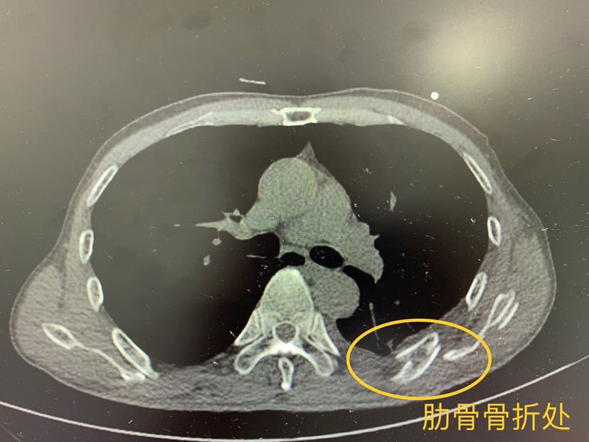 首先,肋骨骨折在胸部外伤中最常见,有闭合性和开放性.