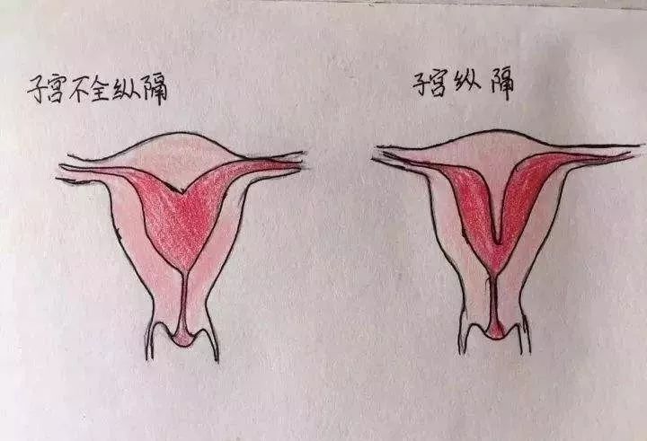 一名纵隔子宫患者的不幸与幸运程亚辉医生分享