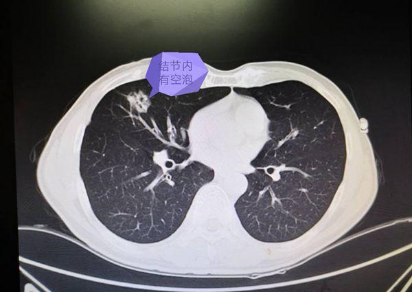 男子咳嗽被当成支气管扩张,却是肺癌:为什么肺癌