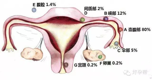 宫外孕究竟有多可怕每个女人都应该了解这些常识