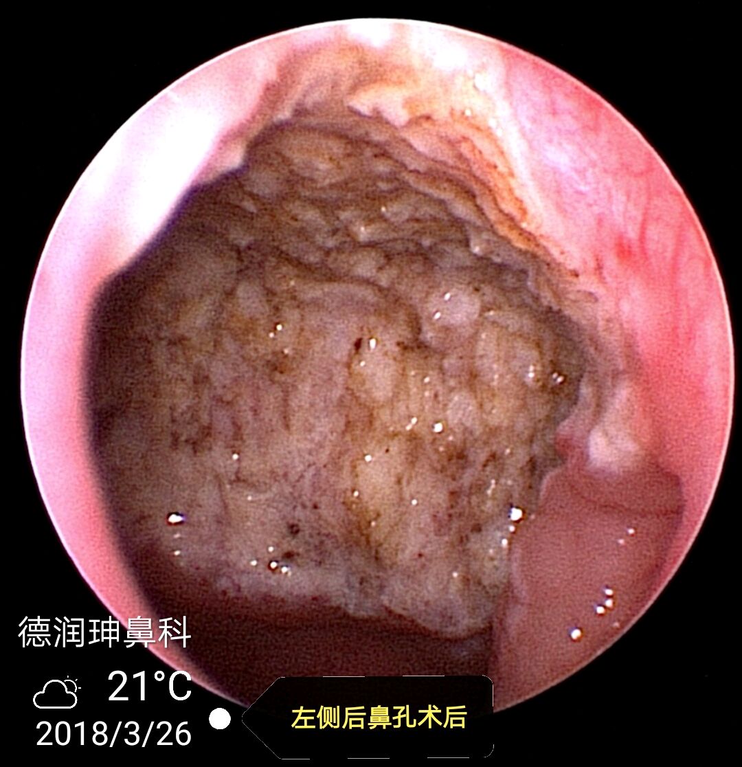 腺样体肥大患儿家长看过来之二_鼻科医生王先忠_新浪
