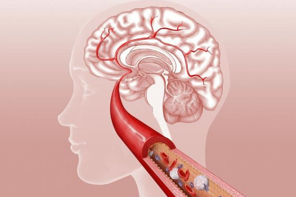 苹果醋姜汁偏方治脑梗_肺癌脑转移的偏方_脑梗塞偏方