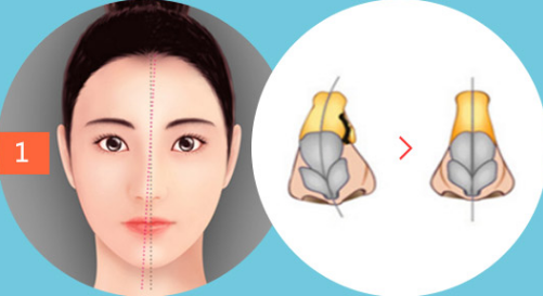 这些明星的鼻子歪成s型还有c型倾斜型