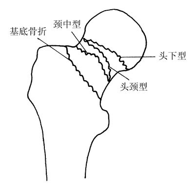 股骨颈骨折的特点及治疗选择