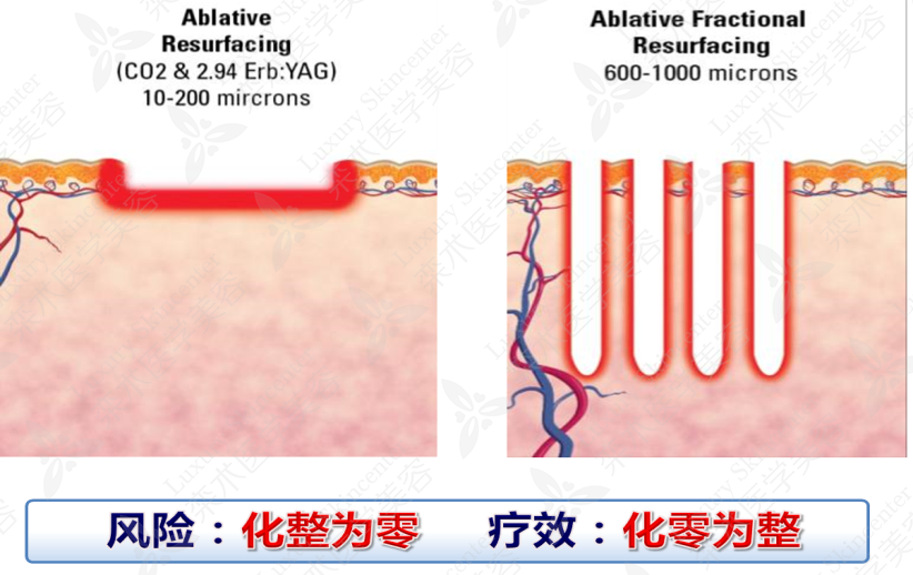 点阵激光,调q激光,皮秒到底有什么差别?