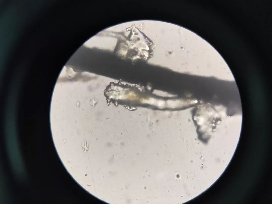 显微镜下后,惊人的一幕出现了:几只肥硕的蠕形螨虫正攀附在睫毛上蠕动