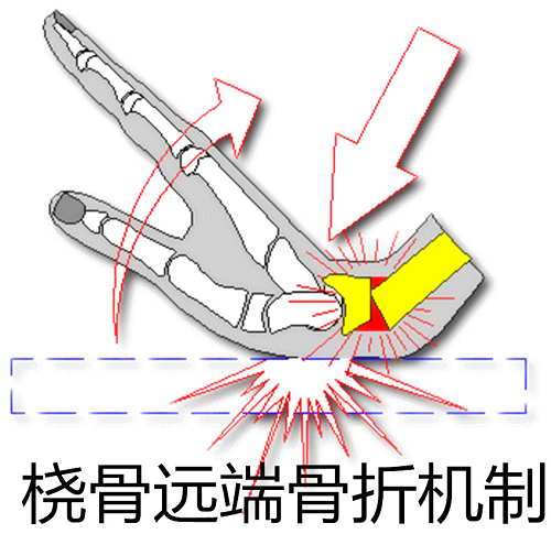 过年的骨科故事手腕受伤了该怎么办