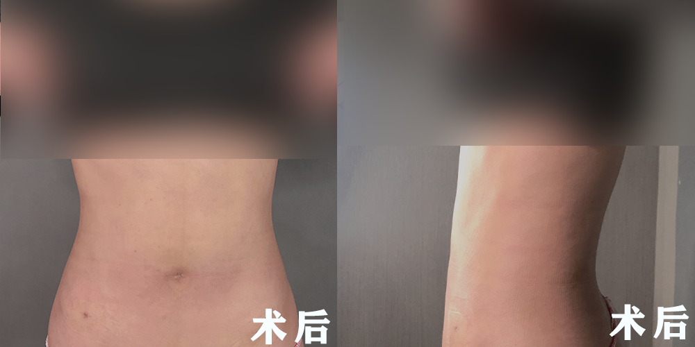 内脏脂肪和皮下脂肪,究竟是什么导致你"胖"的?哪个更容易减?