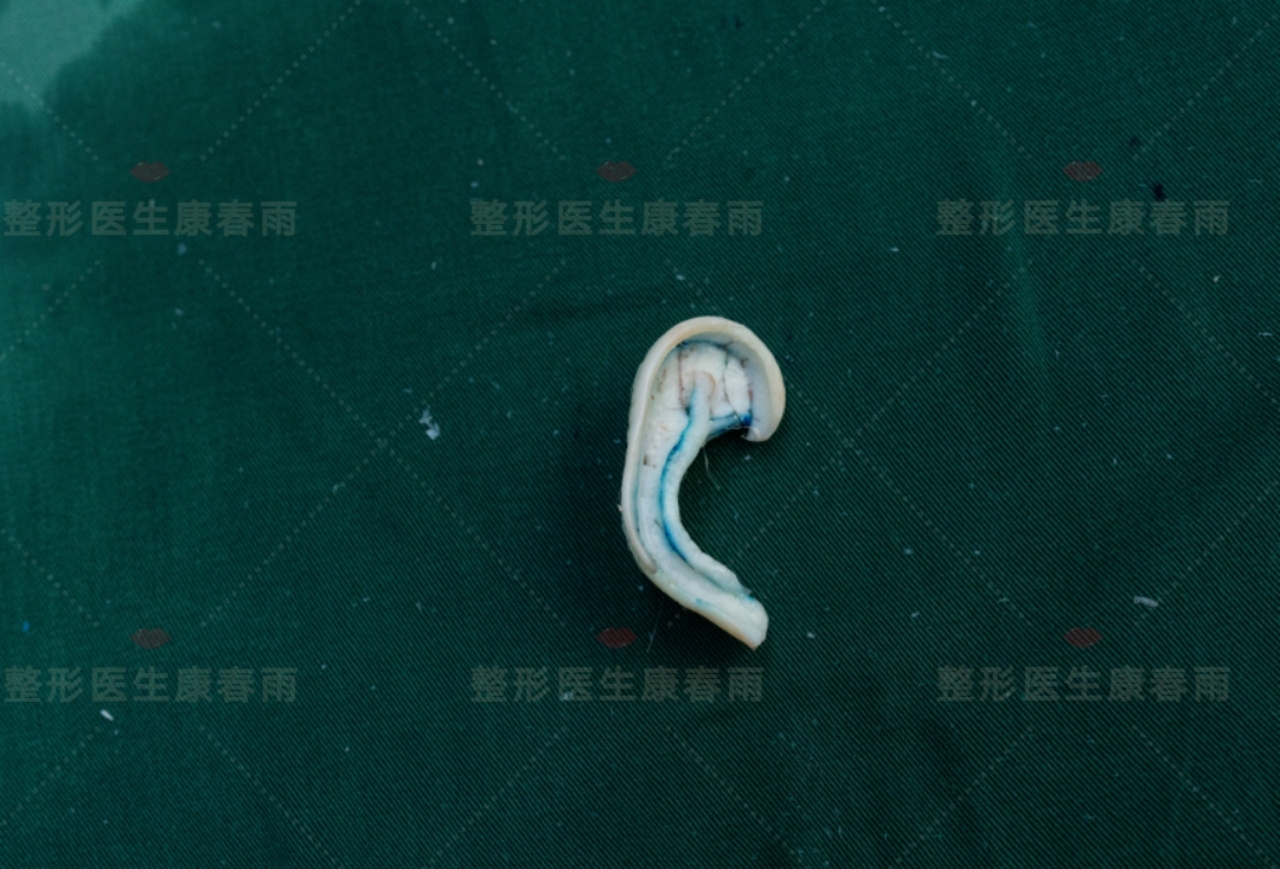 (雕刻成型的肋软骨支架)