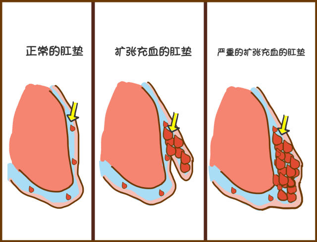 你痔疮?这么巧,我也是!