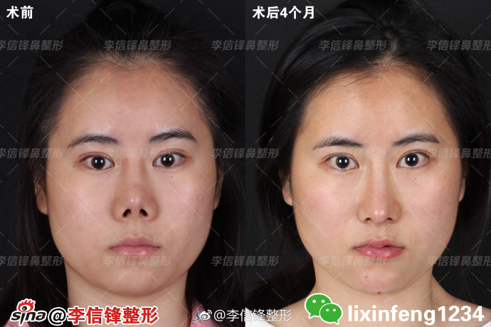 三,为什么l型假体隆鼻会出现鼻尖下垂,或挛缩变短等情况?