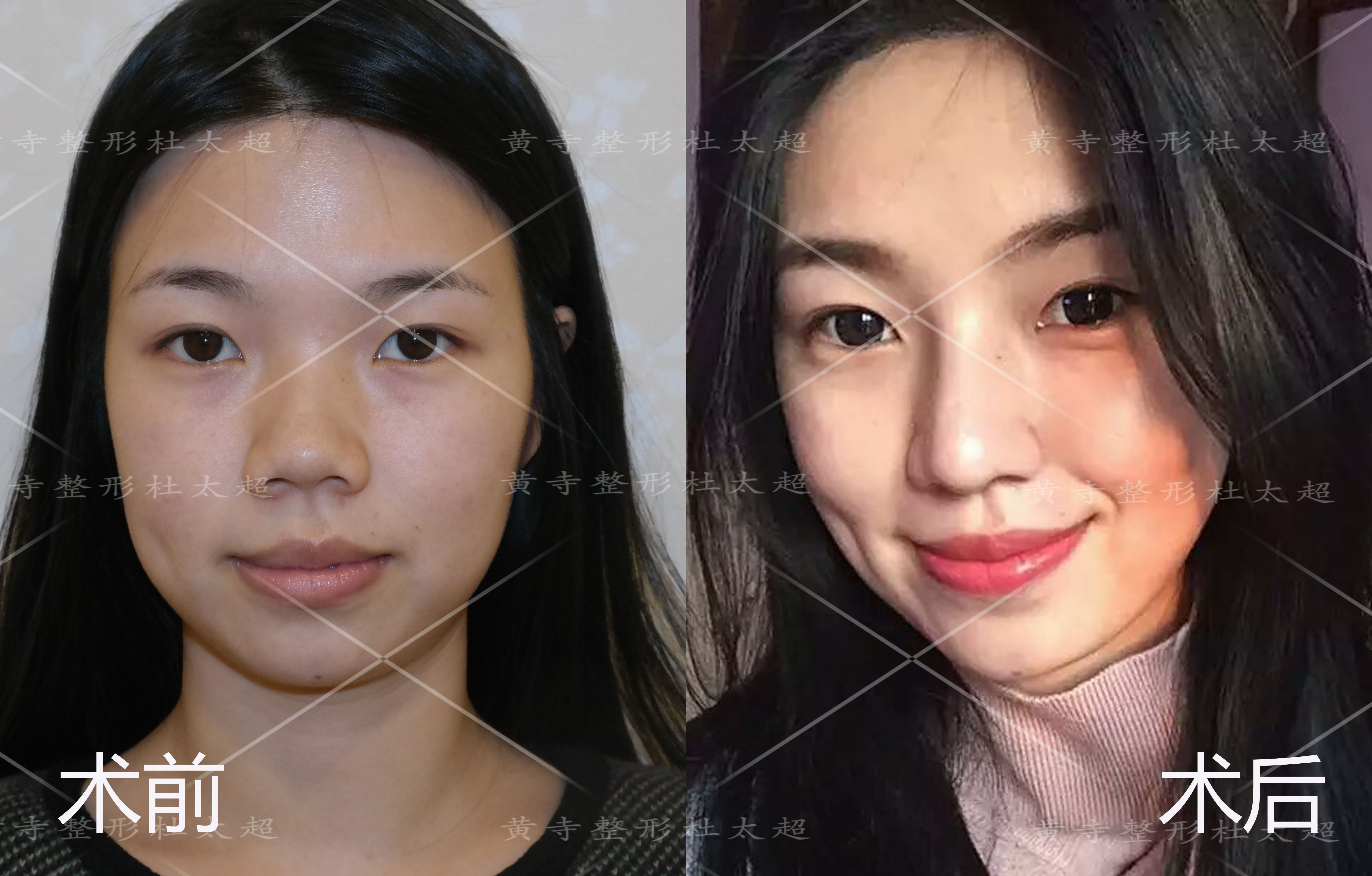 现在大家应该都知道,鼻型漂亮与否与鼻头鼻翼都是相关的,如果鼻头鼻翼