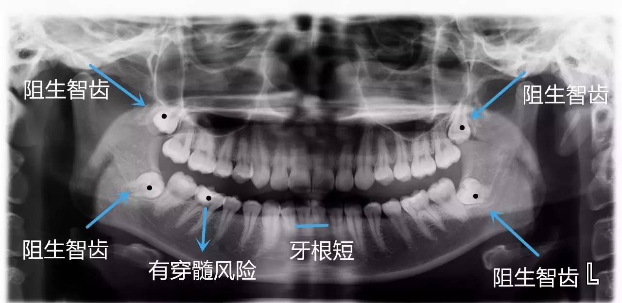 整副牙齿的情况,牙胚的发育情况,是否有多生牙,智齿的萌出是否正常