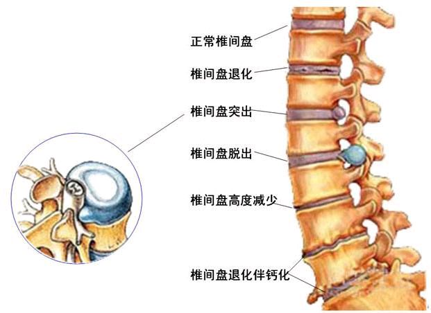 腰椎间盘突出能通过按摩按回去吗?