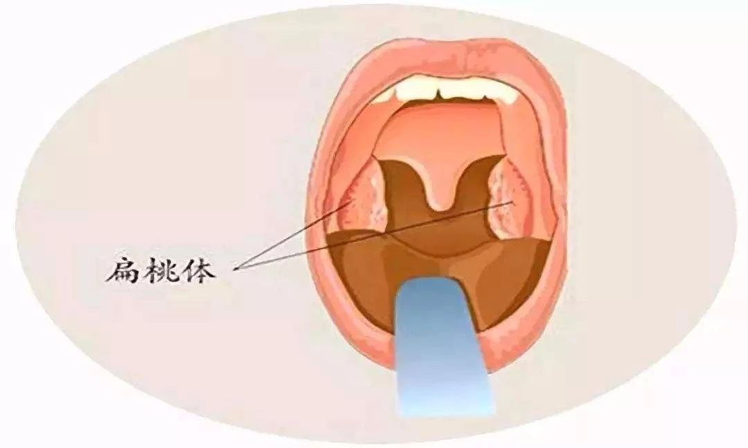 的颚扁桃体(palatine tonsils),位于咽峡的侧壁,舌腭弓和咽腭弓之间