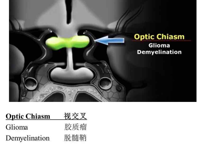 视交叉的病变