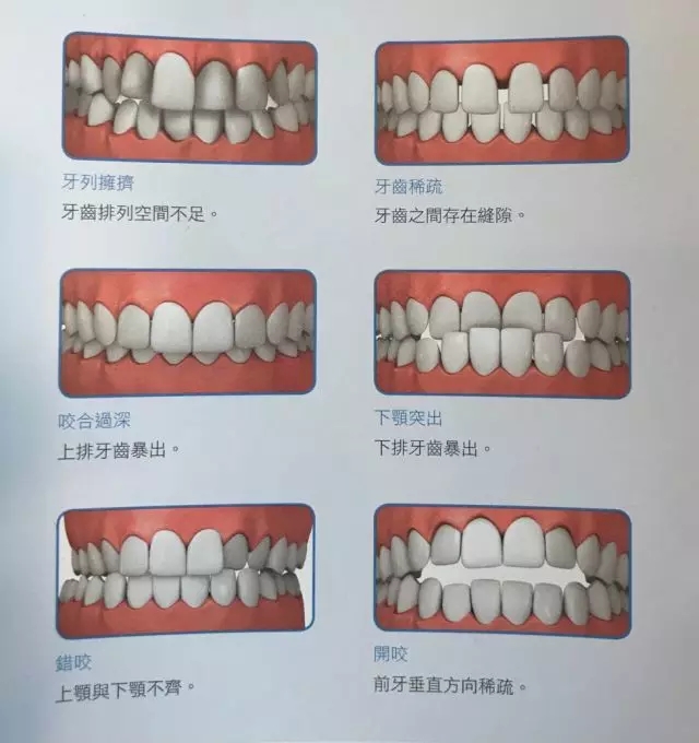 2,调整牙齿的咬合关系