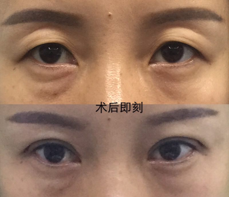 出现了三角眼,严重时出现倒睫毛睁眼困难.