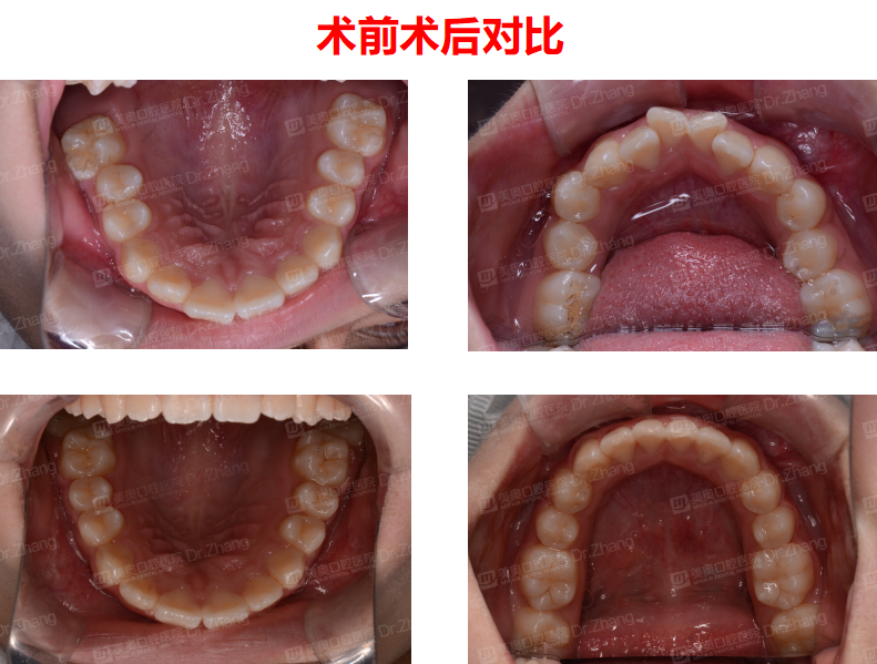 长沙牙齿矫案例:13岁女孩牙列不齐,扩弓排齐整平上下牙列