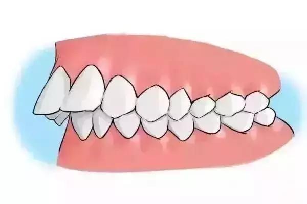 牙齿矫正不仅仅是排齐牙齿,更注重牙齿的咬合关系