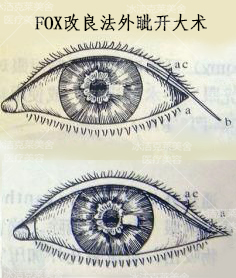 fox改良法外眦开大术,让小眼睛变成大眼睛已经不再是遥不可及.