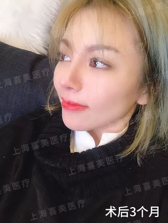 真人案例鼻孔严重歪斜导致姑娘的鼻子都畸形了