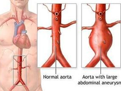 胸腹主动脉瘤的治疗原则和最新进展