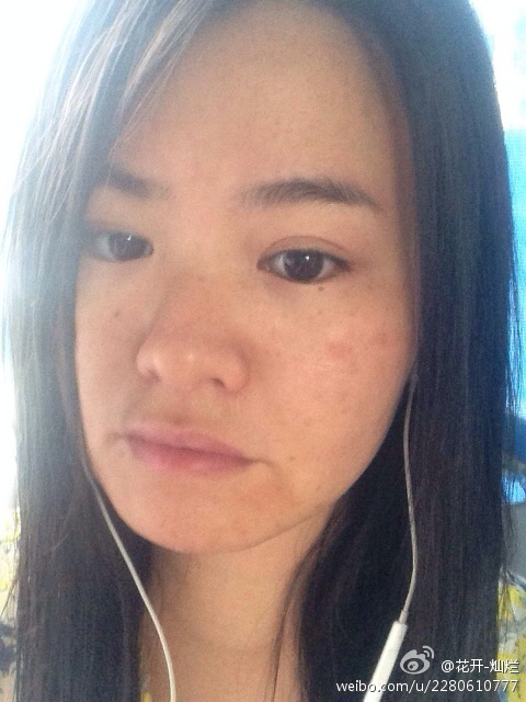 怎样才能少长痘痘-怎么样才能治疗痘痘|怎么样