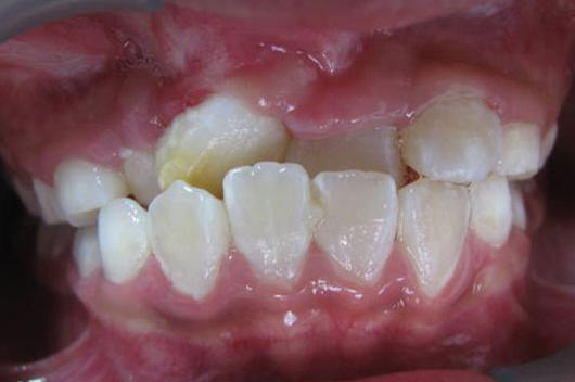 12岁前必须矫正的儿童牙颌畸形