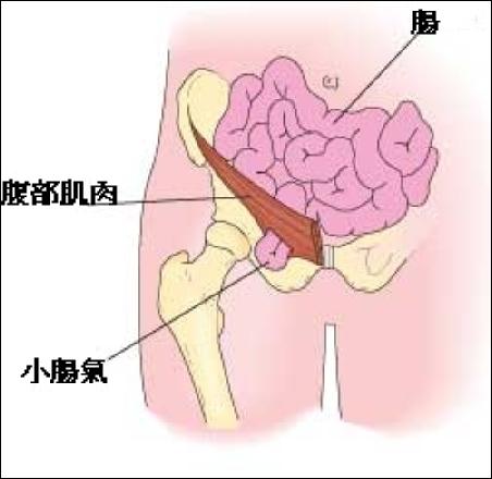 这可能是"疝疾病"的一种,疝是一种常见的疾病,俗称"小肠气"或"疝气"