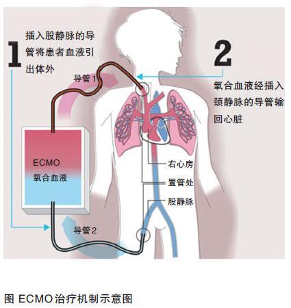 人工肺每天都得10多万医生告诉你到底需要多少钱都谁在用